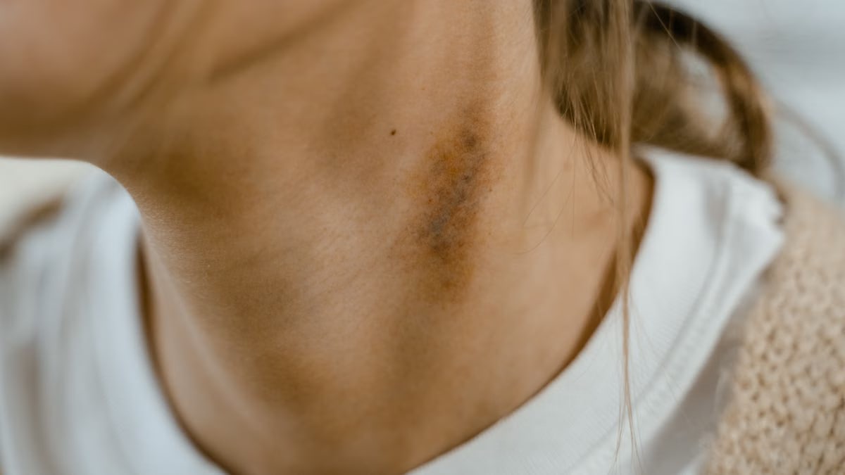 Detailed close-up image of a neck showing a visible bruise or scar, emphasizing skin texture.